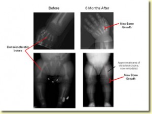 Mason's 6 month Post Transplant X-Rays showing new bone growth